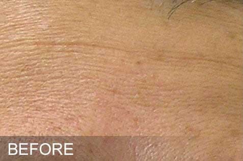 HydraFacial