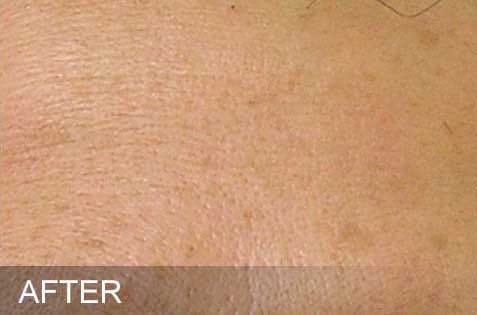 HydraFacial