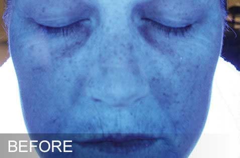 HydraFacial