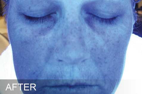 HydraFacial