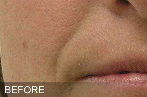 HydraFacial