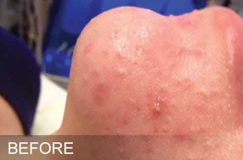 HydraFacial
