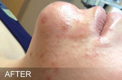 HydraFacial