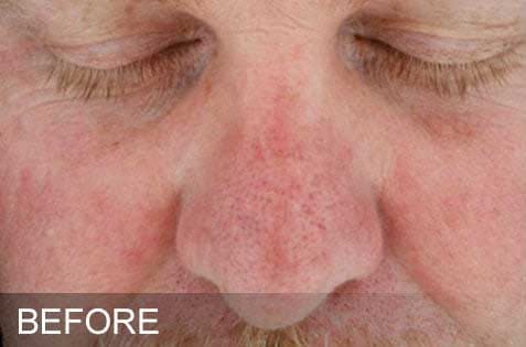 HydraFacial