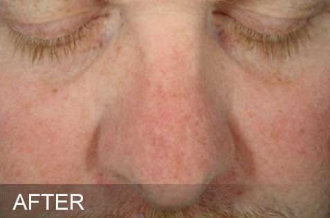 HydraFacial