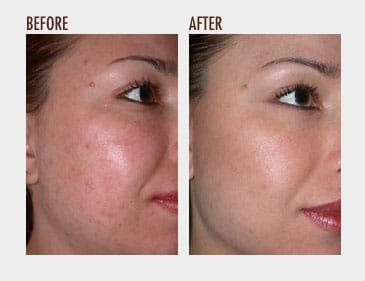 Microdermabrasion